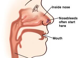 how to stop nose bleeding